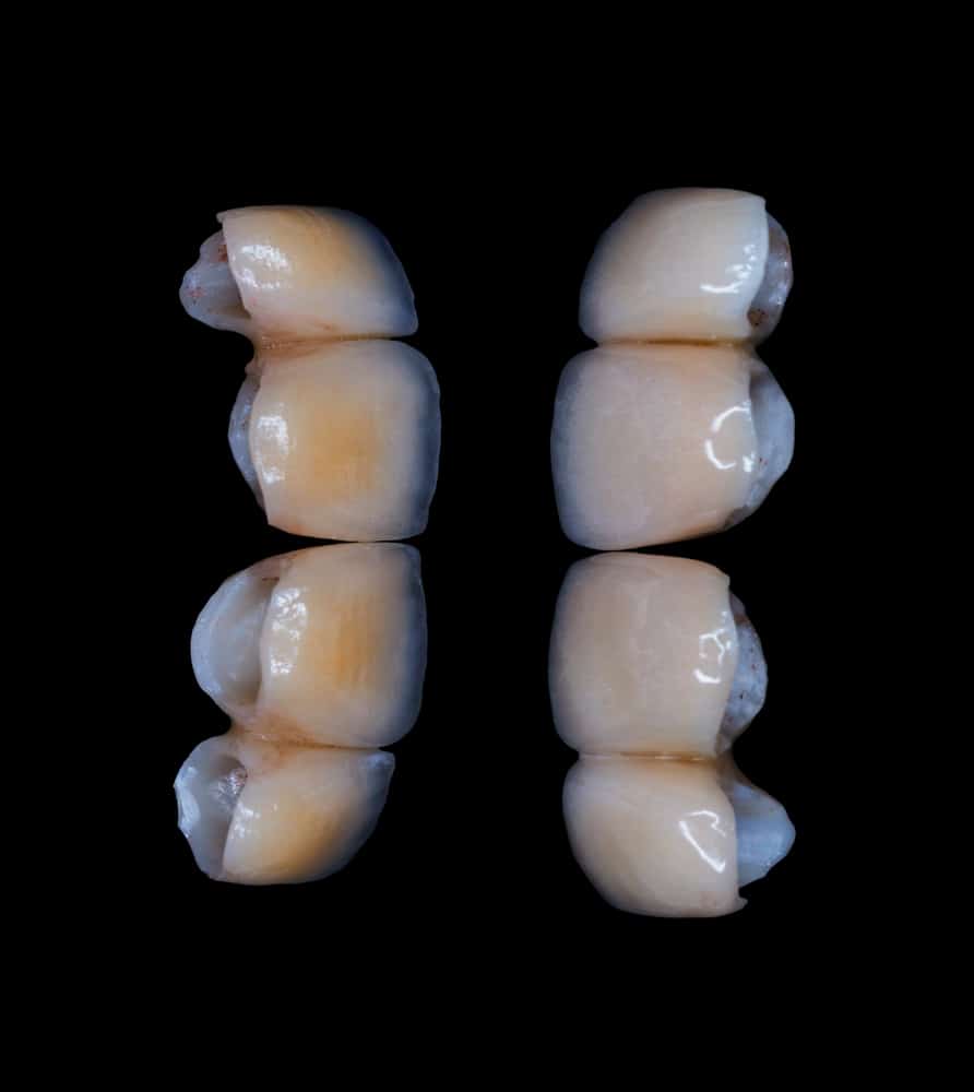 veneers vs whitening