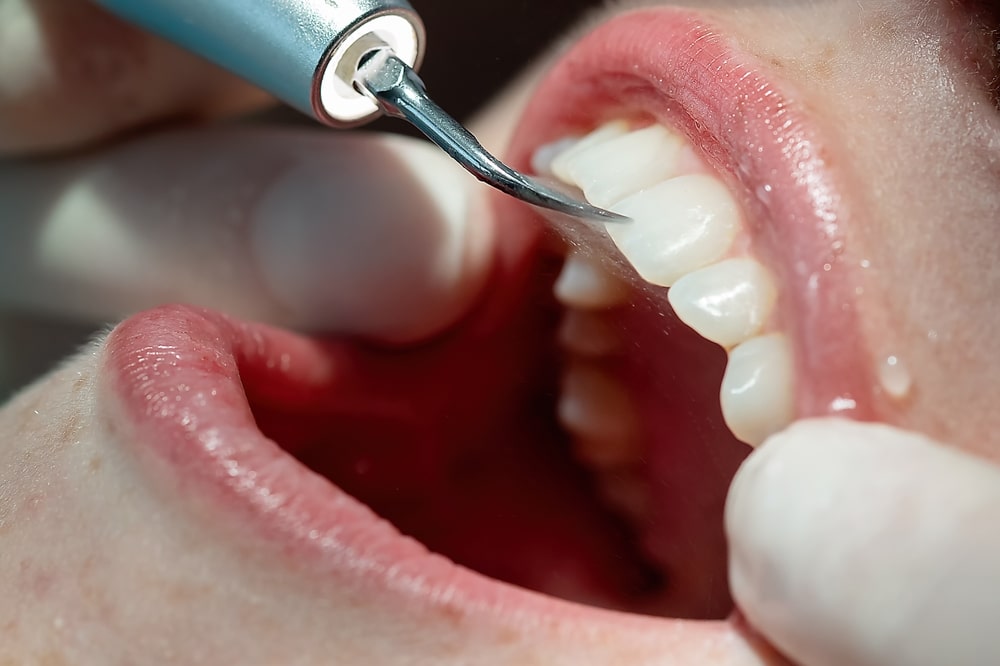 benefits of dental cleaning